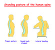 Standing posture of the human spine. Defects of the human spine. Correct alignment of human body in standing posture. vector illustration
