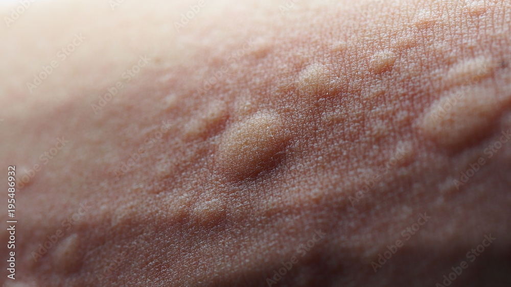 Macro image of symptoms of itchy urticaria or rash
