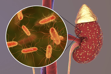 Poster - Pyelonephritis, medical concept, and close-up view of bacteria Escherichia coli, the common causative agent of kidney infection, 3D illustration