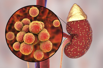 Poster - Pyelonephritis, medical concept, and close-up view of bacteria Staphylococcus, the common causative agent of kidney infection, 3D illustration