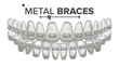 © PikePicture - Metal Braces Vector. Human Jaw. Braces On Teeth. Smile With Braces. 3D Realistic Isolated Illustration