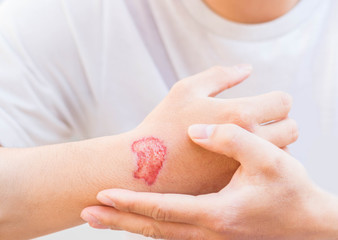 Man show lesion or wound on his arm after accident