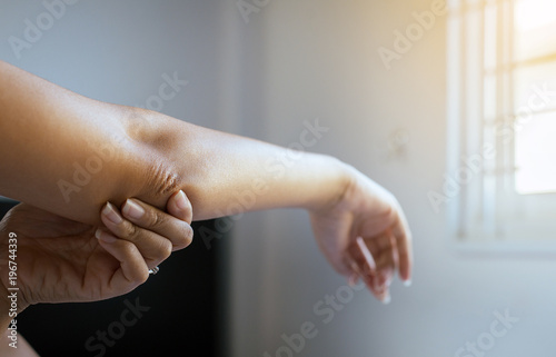 Fotografía Close up of woman with dry skin on elbow and arm,Body and health care concept,Se