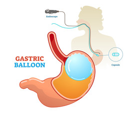 Gastric balloon medical procedure concept diagram, vector illustration. Weight loss and obesity treatment. 