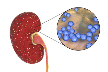 Poster - Acute pyelonephritis, medical concept, and close-up view of bacteria Enterococcus, the common causative agent of kidney infection, 3D illustration