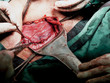Close up of surgical field with uterus and blood, doctor or surgeon hands wearing surgical glove closing uterus by needles suture after cesarean section