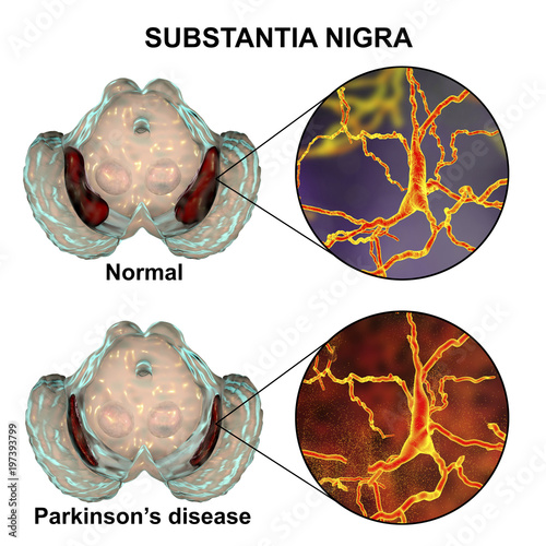 Substantia Nigra In Norm And In Parkinson S Disease 3d Illustration Showing Decrease Of Its Volume There Is Degeneration Of Dopaminergic Neurons In The Pars Compacta Of The Substantia Nigra Buy This