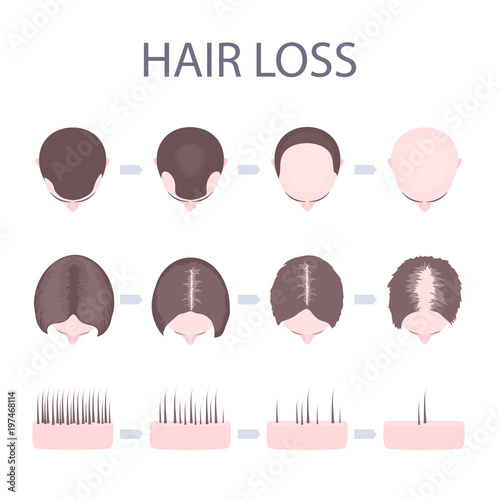 Male and female pattern hair loss set. Stages of baldness in men and women. Number of follicles on scalp in each step. Alopecia infographic medical vector template for clinics and diagnostics centres.