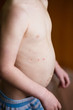 © Ольга Тернавская - Baby with chicken pox rash. Varicella virus or Chickenpox bubble rash on child. Dermatology concept. Toddler shows blemishes on his belly