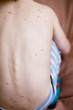 © Ольга Тернавская - Baby with chicken pox rash. Varicella virus or Chickenpox bubble rash on child. Dermatology concept. Toddler shows blemishes on his back