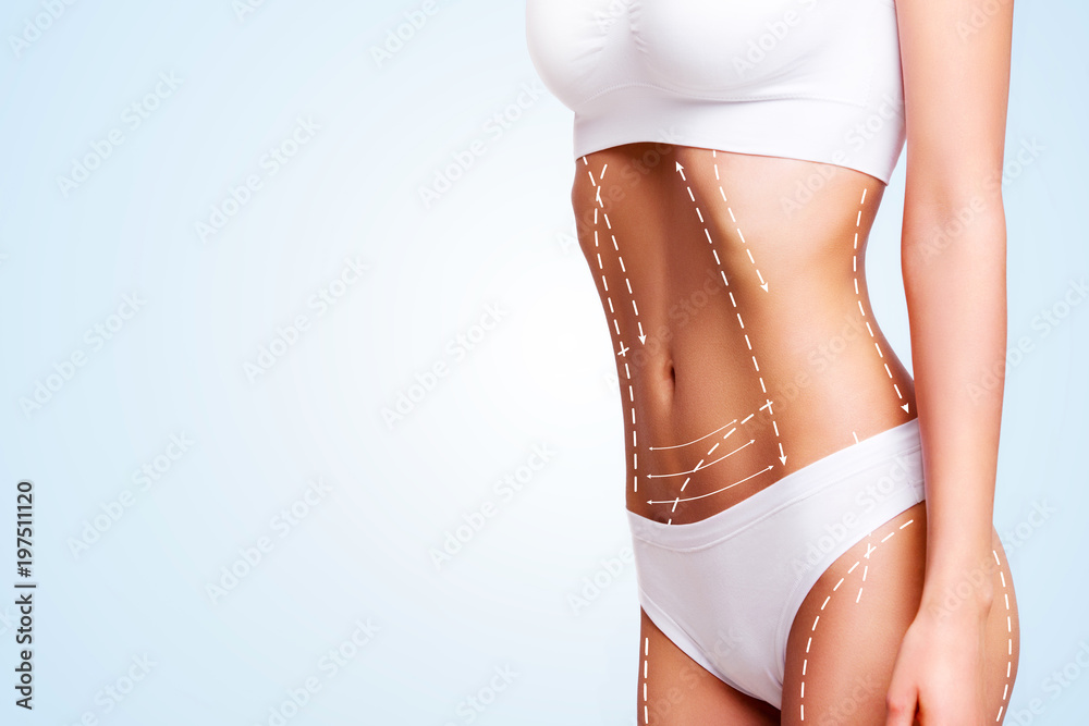 Female body cosmetic surgery and skin liposuction. - obrazy, fototapety, plakaty 
