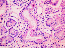 Cytomegalovirus CMV Infection In The Salivary Gland Viewed At 400x Magnification With Haemotoxylin And Eosin Staining