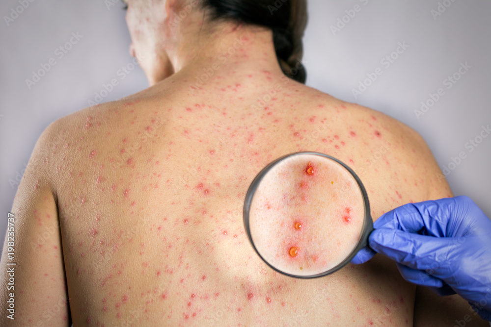 medical research chickenpox viral infection concept. girls back skin ...