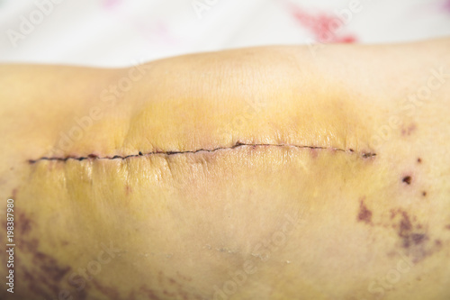 Patient month after surgery, long scar on knee Control of healing, clear the skin. Hospital health care. knee prosthesis postoperative - Buy this stock photo and explore similar images at Adobe Stock | Patient month after surgery, long scar on knee Control of healing, clear the skin. Hospital health care. knee prosthesis postoperative - Buy this stock photo and explore similar images at Adobe Stock |