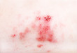 © lial88 - Atopic dermatitis (AD), also known as atopic eczema, is a type of inflammation of the skin (dermatitis) at foot.