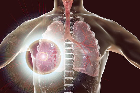 Lung cancer, illustration
