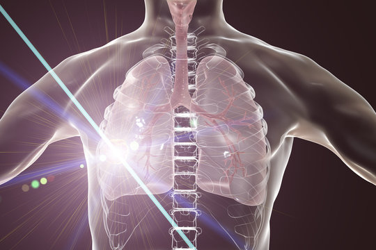 Lung cancer, illustration