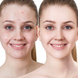 Young woman with acne before and after treatment.