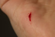 © burdun - deep cut caused by knife in hand palm