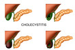 liver, gall bladder and pancreas. cholecystitis