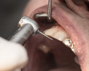 Wall Mural - A dentist makes teeth to a woman