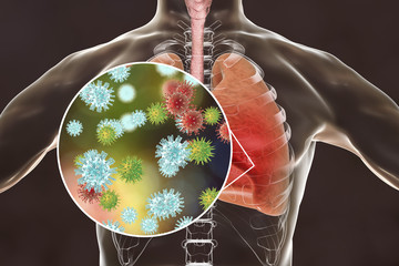 Poster - Viruses in human lungs, 3D illustration. Conceptual image for viral pneumonia, flu, MERS-CoV, SARS, Adenoviruses and other respiratory viruses