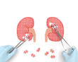 Kidneys operation puzzle concept: hands of surgeon with surgical instruments (tools) performs kidney surgery as a result of renal failure (nephrism), urinary stone disease, urosepsis, kidney cyst