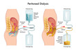 vector medical illustration of  procedure of peritoneal dialysis