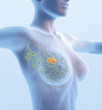 Breast cancer, lymphatics, mastocarcinoma, sentinel lymph node, medical illustration