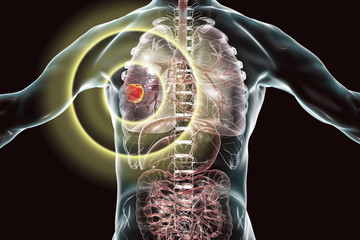 Poster - Lung cancer treatment and prevention concept, 3D illustration