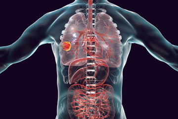 Sticker - Lung cancer, medical concept, 3D illustration showing cancerous tumor inside human lung