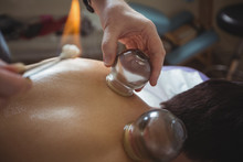 Therapist Giving Fire Cupping Therapy To Man