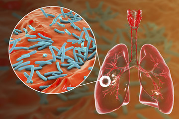 Wall Mural - Fibrous-cavernous pulmonary tuberculosis and close-up view of Mycobacterium tuberculosis bacteria, 3D illustration showing cavity in the lung