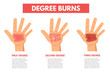 Degree burns of skin. Infographic Vector illustration.
