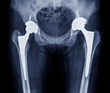 total hip replacement, osteoarthritis of hip joint , artificial hip joint, hip pain