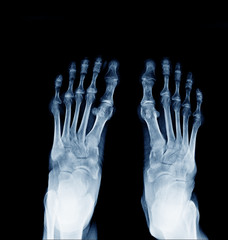 X-ray image of normal foot both side