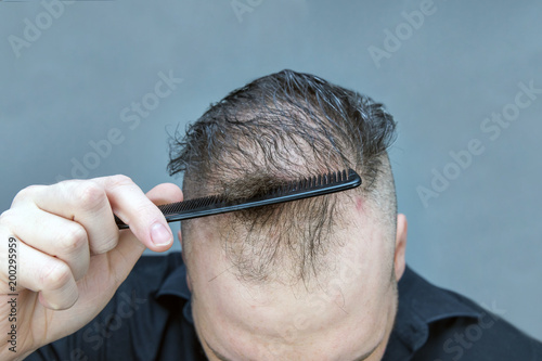 Young Man With Thinning Hair Buy This Stock Photo And Explore