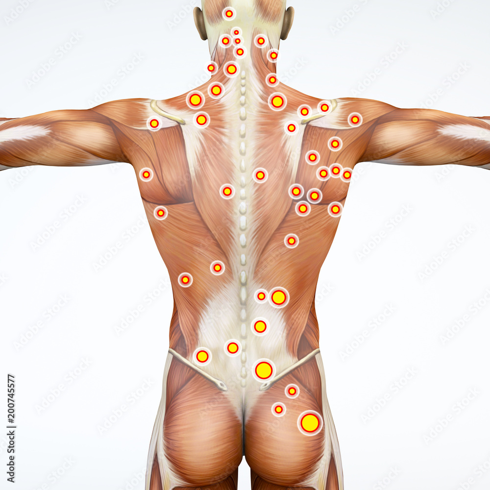Vista di spalle di una persona, muscoli della schiena con i trigger points evidenziati. Anatomia e corpo umano - obrazy, fototapety, plakaty 