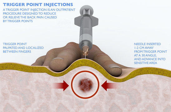 Un'iniezione nei trigger points è una procedura per ridurre o alleviare il mal di schiena causato dai punti trigger. Iniezione intramuscolare, puntura sotto pelle con siringa. 3d rendering