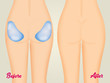 illustration of buttocks implants