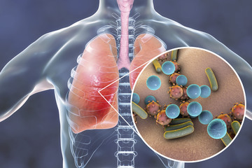 Wall Mural - Pneumonia, medical concept, 3D illustration showing human lungs and close-up view of microbes in lungs