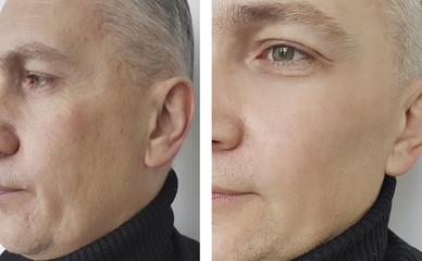 face man wrinkles before and after,