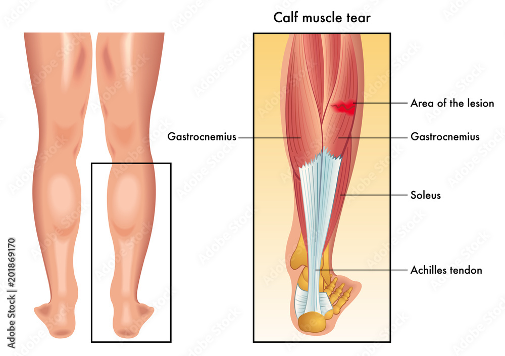 vector-medical-illustration-of-the-symptoms-of-calf-muscle-tear-stock