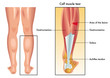 vector medical illustration of the symptoms of calf muscle tear