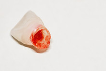 Extracted Baby Tooth With Blood On Light Background. Closeup, Selective Focus