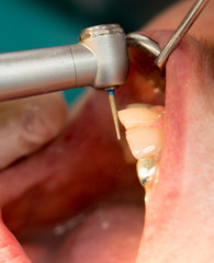 Wall Mural - A dentist makes teeth to a woman