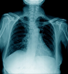 Poster - chest x-ray in blue tone, x-ray chest of old man AP and part of shoulder