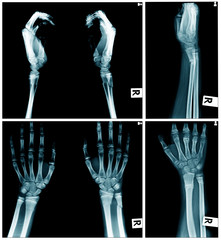 Canvas Print - collection of x-ray image, hand x-ray AP and laterl view