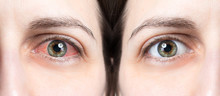 Red Eye Before And After Using Eye Drops
