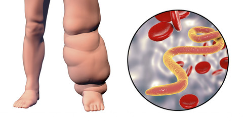 Wall Mural - Leg of a person with elephantiasis, or lymphatic filariasis and close-up view of microfilariae in blood, 3D illustration. A disease caused by worms Wuchereria bancrofti, transmitted by mosquito bite